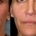 Where are Restylane Fillers Produced? An Expert's Perspective